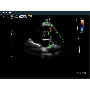Szív Color Doppler képe - MySono U6